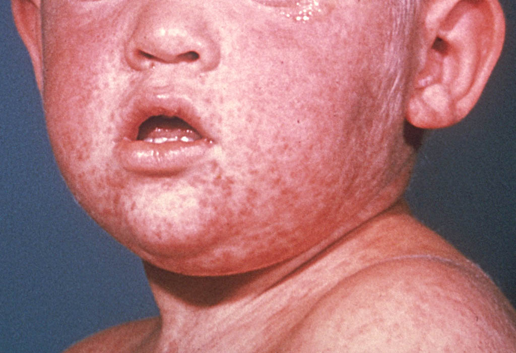 How Measles Impacts Your Immune System Curious