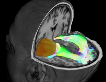 MRI image of a brain