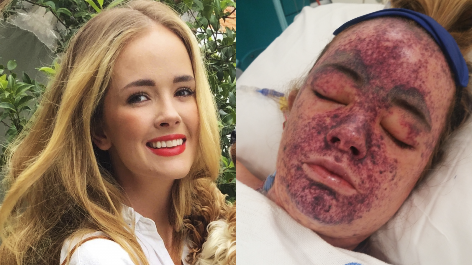 Meningococcal disease spike prompts vaccination call